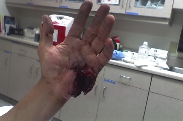 Hand injury caused by cheap single-valve cardboard waste stripper